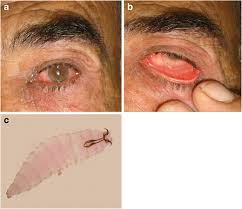 I know i have morgellons aka fly myasis this is working on my 3rd yr. Two Different Myiasis Cases In Southeast Of Turkey Ophthalmomyiasis And Cutaneous Myiasis Springerlink