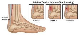 Achilles tendinopathy is most often caused by overuse or achilles tendon rupture is most often caused by a sudden, forceful motion that stresses the calf the pain may come on gradually or may only occur when you walk or run. Are You Suffering From Achilles Tendon Pain Specialized Orthopedic Physical Therapy