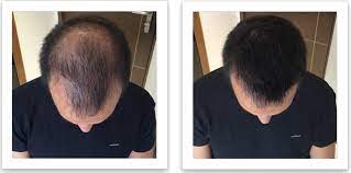 We detail how foreigners and expats can officially secure a mypr, the malaysian permanent resident identity card and what are the benefits entailed. Platelet Rich Plasma In Malaysia Prp Malaysia