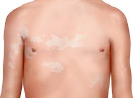 Based on studies, the skin disorder is often seen in children ages 6 to 12. Kleienpilzflechte Barmer
