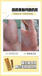 手掌敏感已久经朋友推荐用 苗王癣毒膏搽2天就好了一个月了都没复发 皮肤病克星 naturewellness in 2021