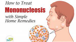 How To Treat Mononucleosis With Simple Home Remedies | Fab How