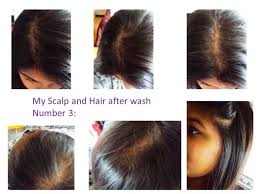 This is the only medication that is known to treat dandruff and leave the scalp completely clean and healthy. Nioxin Nioxin Hair System Kit 2 Noticeably Thinning Hair Review Beauty Bulletin Treatments Masks
