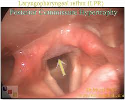 Image result for Reflux Laryngitis
