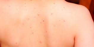 Dec 22, 2017 · chickenpox is an infection caused by the varicella zoster virus. Mthnsqh13ecigm