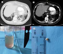 Image result for Broncholithiasis