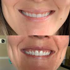 Often, it is your smile that makes your first impression, and if you have concerns about its appearance, we can help. I M Done It S Worth It People 14 Trays Gum Lift And Bonding Biggest Change Is I Smile Wider Because I M Not Self Conscious About My Gums Invisalign