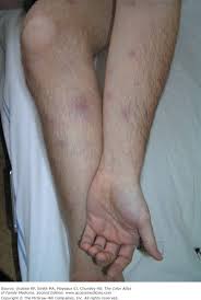 Image result for erythema nodosum