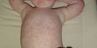 Harus kita ketahui, bintik merah pada kulit bayi menjadi salah satu pertanda awal adanya sebuah memang, bintik merang biasa terjadi pada kulit bayi. Roseola Infantum Pada Bayi Gejala Penyebab Dan Cara Mengatasi