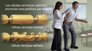 In very rare cases, people have died of. Que Es El Sindrome De Guillain Barre Clinica San Pablo