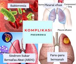 Adakah pesakit akan selamat kerana pesakit adalah. Pneumonia Paru Paru Berair Posts Facebook