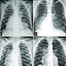 Screening chest xray interpretations_inside_page 41.pdf. Representative Chest X Ray Findings Of Patients With Influenza B Download Scientific Diagram