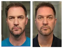 Neora skincare products for facial rejuvenation