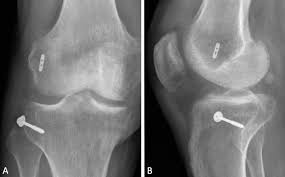 Image result for Segond Fracture