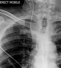 The pressure monitoring assembly is attached to the. Malpositioned Internal Jugular Central Venous Catheter Radiology Case Radiopaedia Org