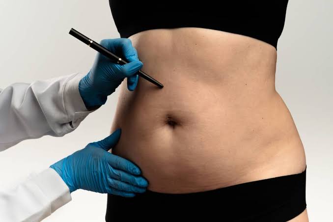 How Many Pounds of Fat Can Liposuction Remove? | Plastic Surgery of Santa  Barbara