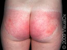 Image result for allergy rash on the legs