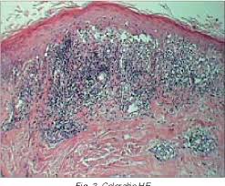 Acoperirea erupției cutanate care apare cu zona zoster cu un pansament sau îmbrăcăminte ajută la scăderea riscului de răspândire a infecției către alții. Pdf Lichen Plan Localizat Zona Zoster Like Lichen Planus Localized Herpes Zoster Like Semantic Scholar