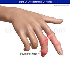 Pin On Arthritis Symptoms