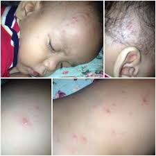 Meskipun batuk dapat sembuh dengan sendirinya. Tips Petua Dan Pantang Larang Untuk Anak Demam Campak Irrayyan Com