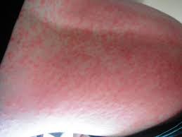 Allergic Reaction To Amoxicillin Rash Hives Oh My Home Remedies
