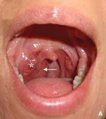 Tumores Parafaringeos Sciencedirect