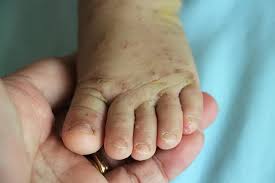 Image result for scabies human children