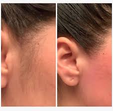 Sideburns area laser hair removal generally takes five to ten minutes per session. Pin By Yoli Baez On Piling Lica Face Wax Facial Waxing Waxing