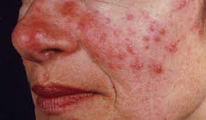 Von acne fulminans spricht man, wenn eine acne conglobata von knochenschmerzen und einer systemischen vaskulitis begleitet ist. Pin On Rosacea