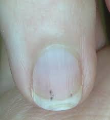 How can i get a deep splinter out? Splinter Hemorrhage Wikipedia