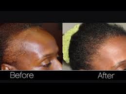 Castor oil is becoming a widespread medication for hair loss and a very effective element for hair regrowth. Black Jamacian Castor Oil For Hair Growth Natural Hair Growth Tips Youtube