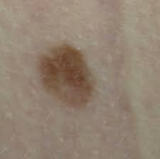 If you have a spot that scabs and crusts over, but the sore is. Skin Cancer Pictures Includes Moles And Other Skin Spots