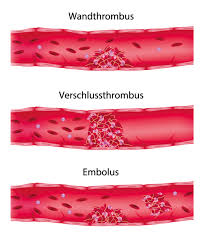Thrombose Symptome Die Typische Anzeichen Erkennen