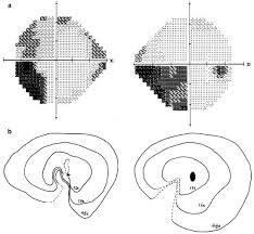 Image result for Visual Field Deficit