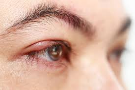 Jenis sakit mata ini sangat menular, peradangan maka pembuluh darah akan melebar dan inilah yang membuat mata menjadi merah. Cari Tahu Penyebab Dasar Mata Bengkak Sebelum Mulai Diobati Alodokter