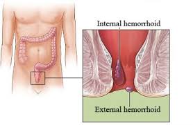 Hämorrhoiden verursachen je nach ihrer ausprägung unterschiedlich schwere beschwerden. Aussere Und Innere Hamorrhoiden Wo Liegen Die Unterschiede