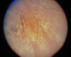 Apmppe is one of the white dot syndromes that occurs in young healthy adults and similarly affects it is usually bilateral, although may be worse in one eye. Acute Posterior Multifocal Placoid Pigment Epitheliopathy Apmppe Background Pathophysiology Epidemiology