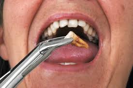 Image result for Tooth Extraction