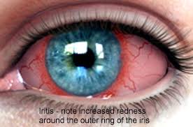 Image result for Ciliary Flush