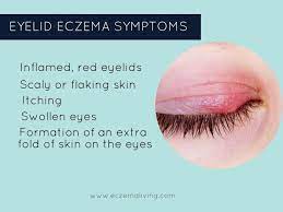 Eyelid Dermatitis How To Get Rid Of Eczema On Eyes Eczema On Eyelids Eyelid Dermatitis Eczema Around Eyes