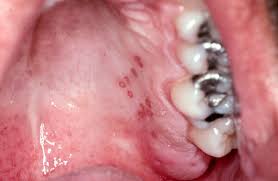 Image result for Mouth ulcers symptoms roof of the mouth