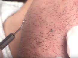 This condition triggers a red, painful little bump that can induce inflammation in the entire areas where it. Video Man Extracts Ingrown Hair That Looks Like Blackhead Insider
