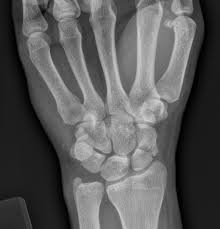 Image result for Scaphoid Bone