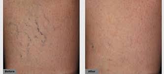 Intravenous injection causes intima inflammation and thrombus formation. Spider Veins Long Beach Heller Dermatology And Aesthetic Surgery