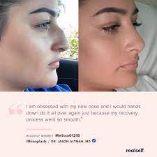 Nose Job Before And After Rhinoplasty Nonsurgical Nose Job Nose Job