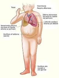 Maybe you would like to learn more about one of these? Insufficienza Cardiaca Wikipedia