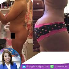 However, the company offers specials and payment options: Brazilian Butt Lift Bbl Surgery In Dominican Republic