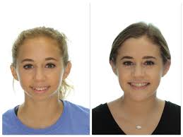 Management of Juvenile Idiopathic Arthritis