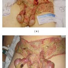 Nord gratefully acknowledges rodolfo l. Fournier S Gangrene Caused By Neisseria Meningitidis A The Patient S Download Scientific Diagram