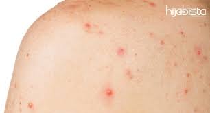 Kita menjadi kurang percaya diri dengan penampilan yang di samping itu, jerawat tersebut sudah pasti akan meninggalkan bekas yang juga sangat sulit untuk dihilangkan. Jerawat Tumbuh Belakang Badan Boleh Murung Kalau Tak Dirawat 8 Tip Mudah Untuk Hijabi Atasinya Tanpa Pening Kepala Hijabista